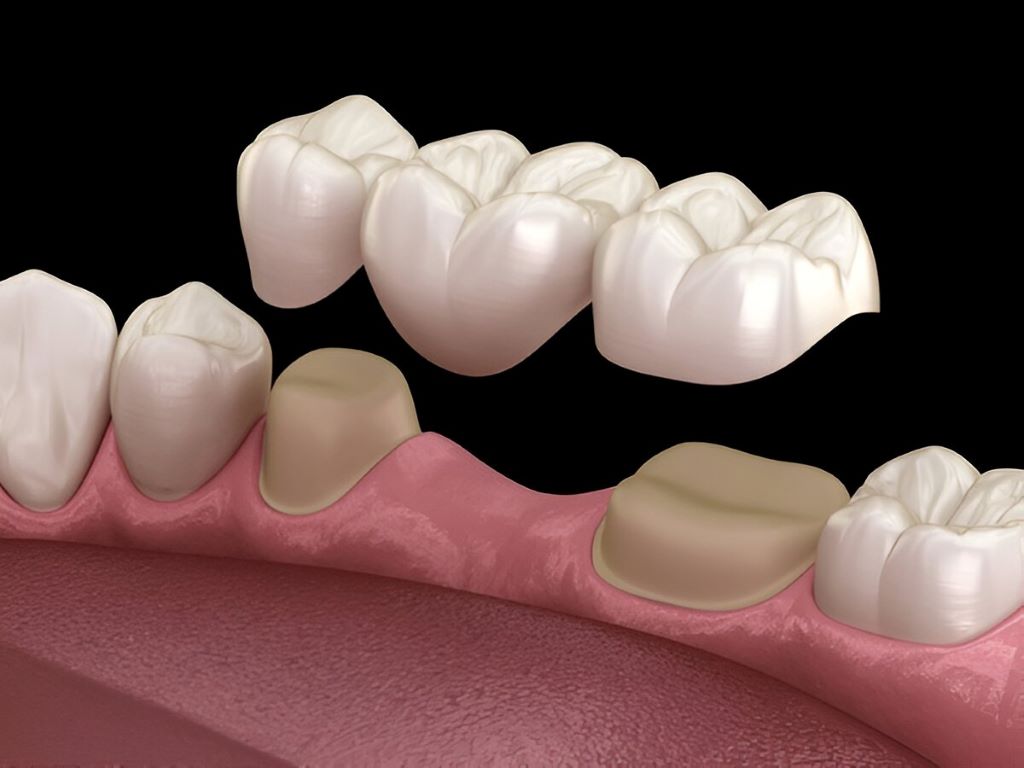 dental bridges nw calgary