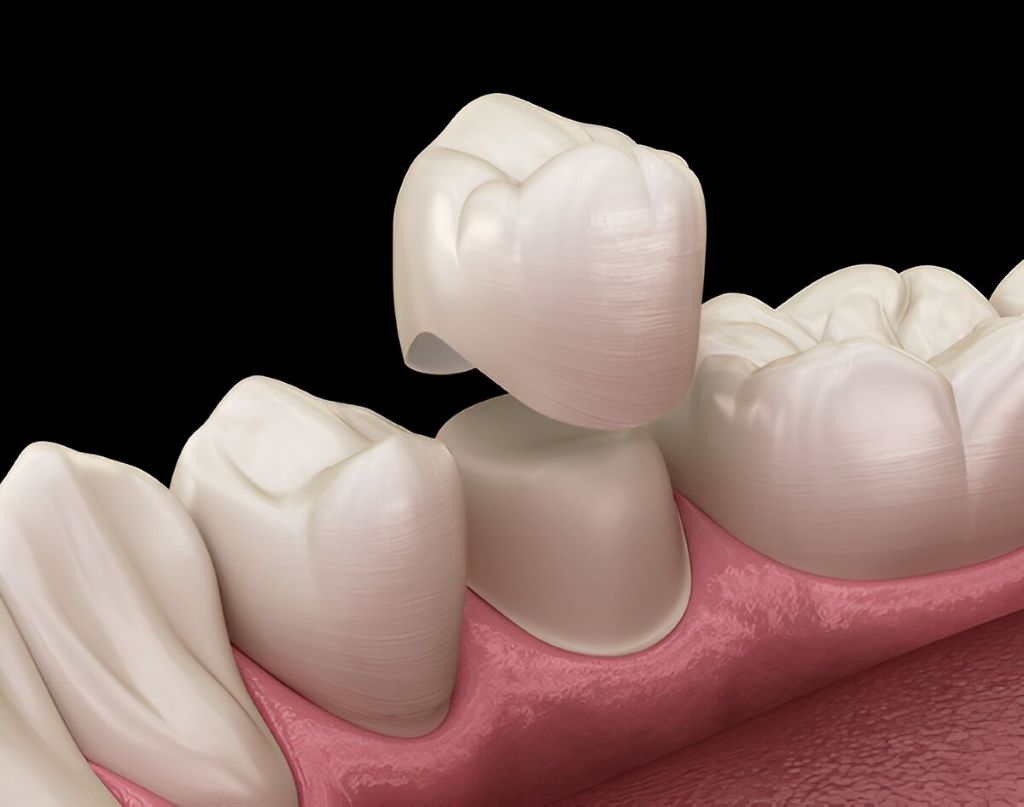dental crowns in nw calgary