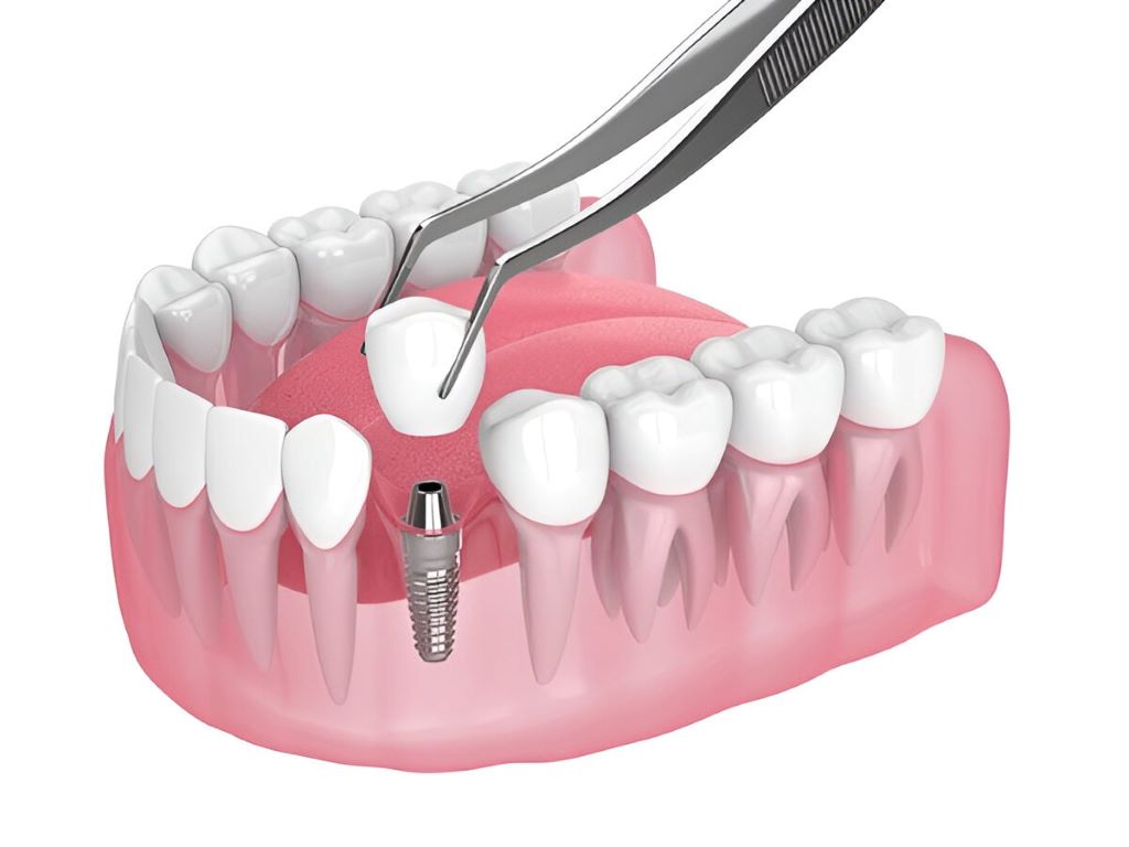 dental implants near you