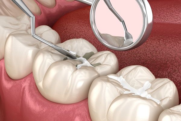 dental sealants nw calgary