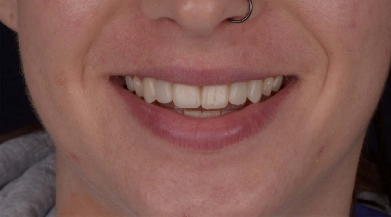 bridges after