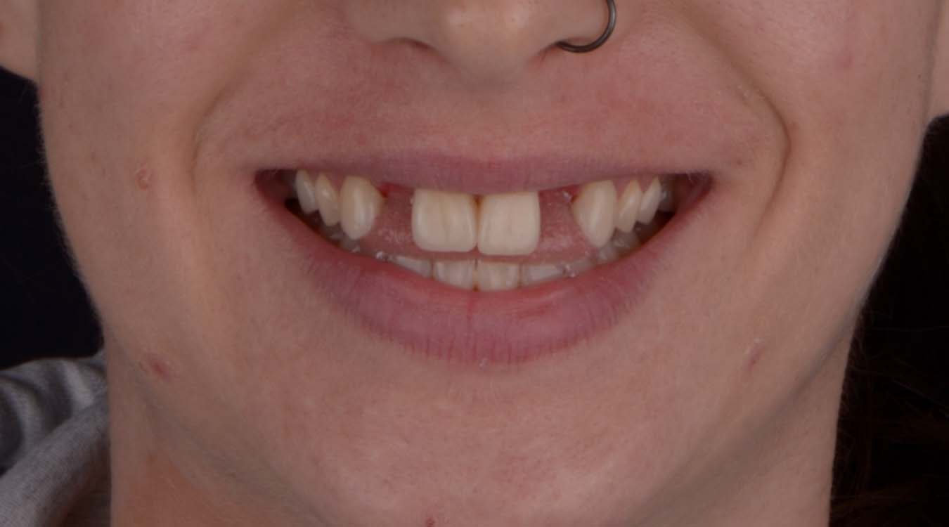bridges before