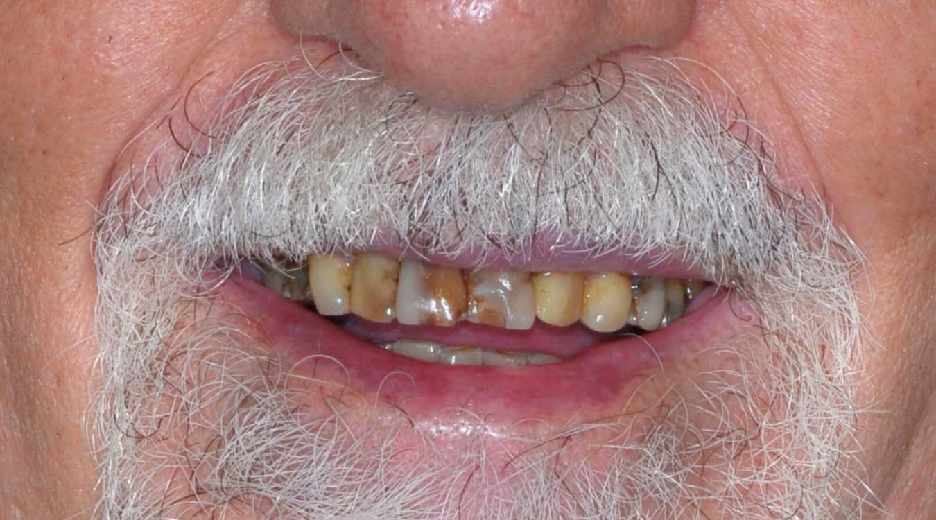 smile rehab after