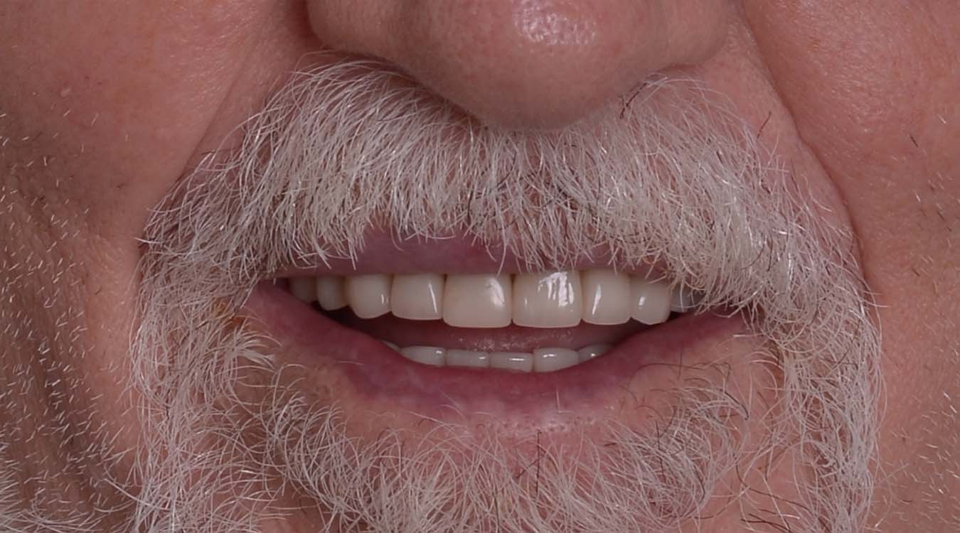 smile rehab before
