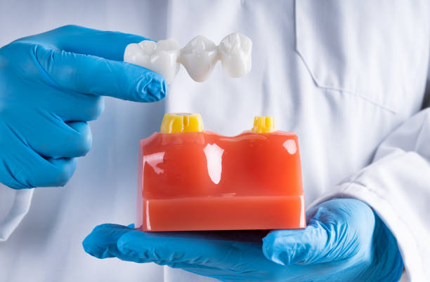 how dental bridges replace missing teeth